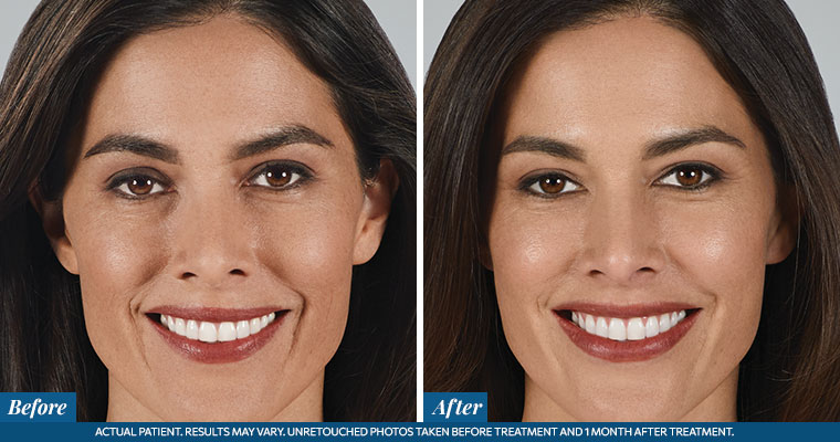 /images/results/img-procedure-results-botox-dysport-01.jpg