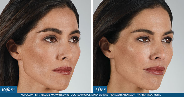 /images/results/img-procedure-results-botox-dysport-02.jpg
