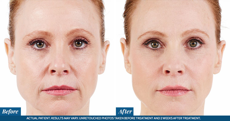 /images/results/img-procedure-results-botox-dysport-03.jpg