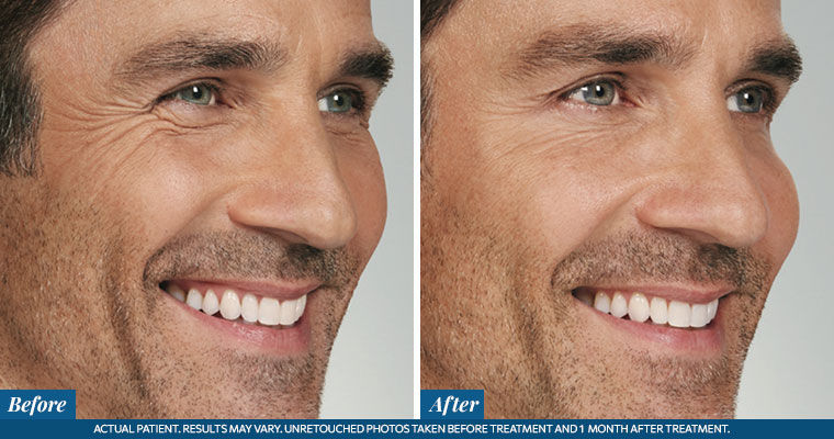 /images/results/img-procedure-results-botox-dysport-04.jpg