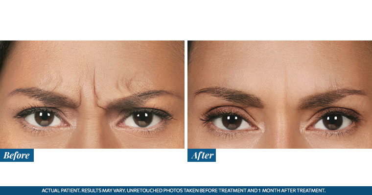 /images/results/img-procedure-results-botox-dysport-05.jpg